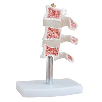 Ľudskej anatómie kostra Osteoporózy Anatomické Stavcov ochorenia Model, komunikácia medzi pacientom a lekárom Zdrojov model