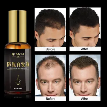 Rast vlasov Podstate Olej pre Rast Vlasov Liečba Anti Strata Vlasov Starostlivosť o Vlasy Vlasové Tonikum Riešenie pre Ženy, Mužov vypadávanie Vlasov