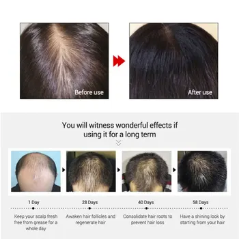 Zázvor Rýchly Rast Vlasov Podstate Esenciálny Olej Anti-Hair Strata Tekutín