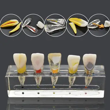 Zubné endodontic patologické predné predné labial zuby model zubné laboratórium stomatológia endo model
